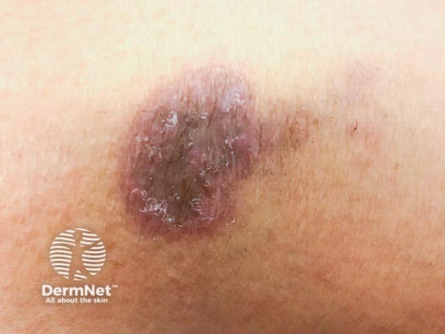 Gambar 1: Lichen planus. Credit: dermnetnz